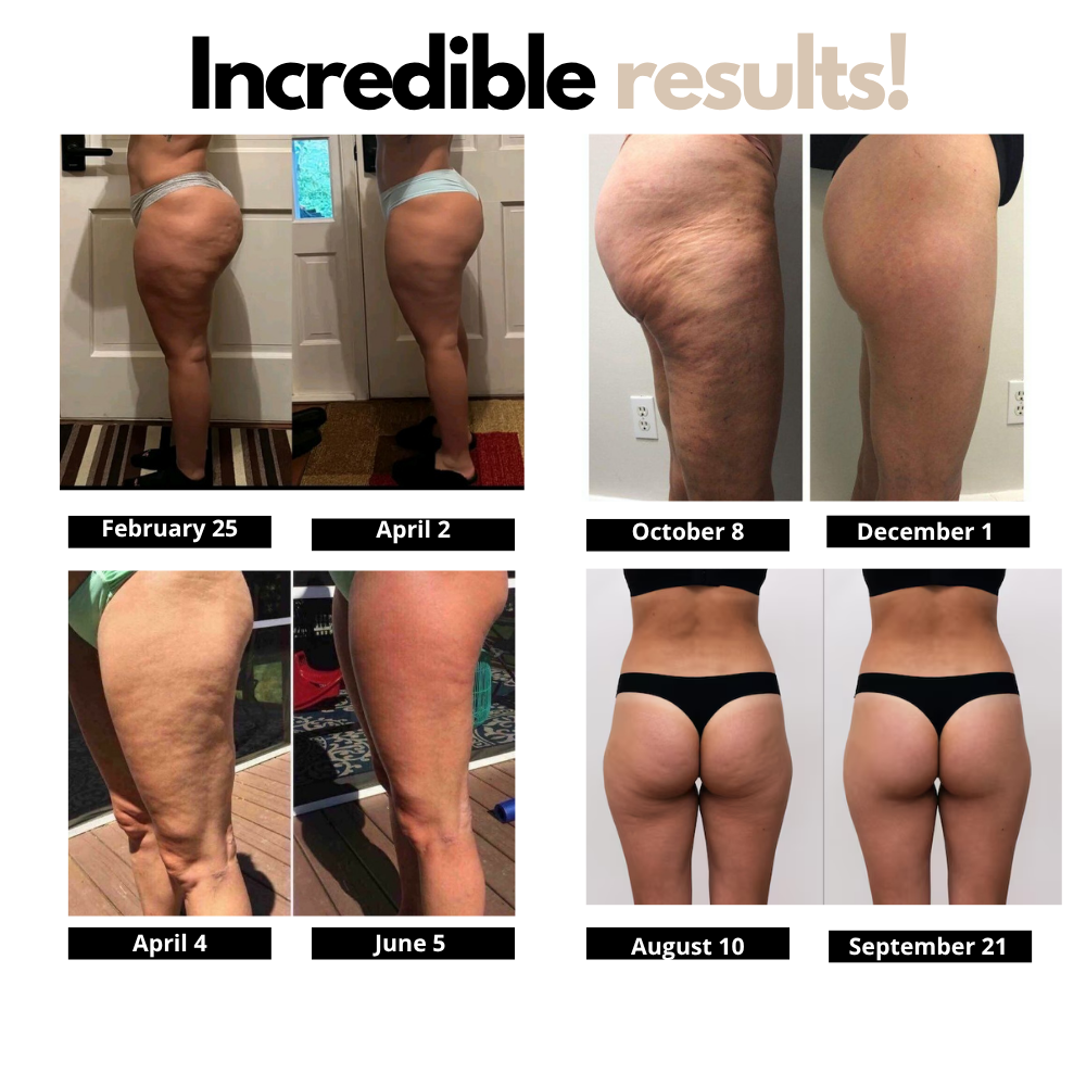 3D Anti-Cellulite Leggings